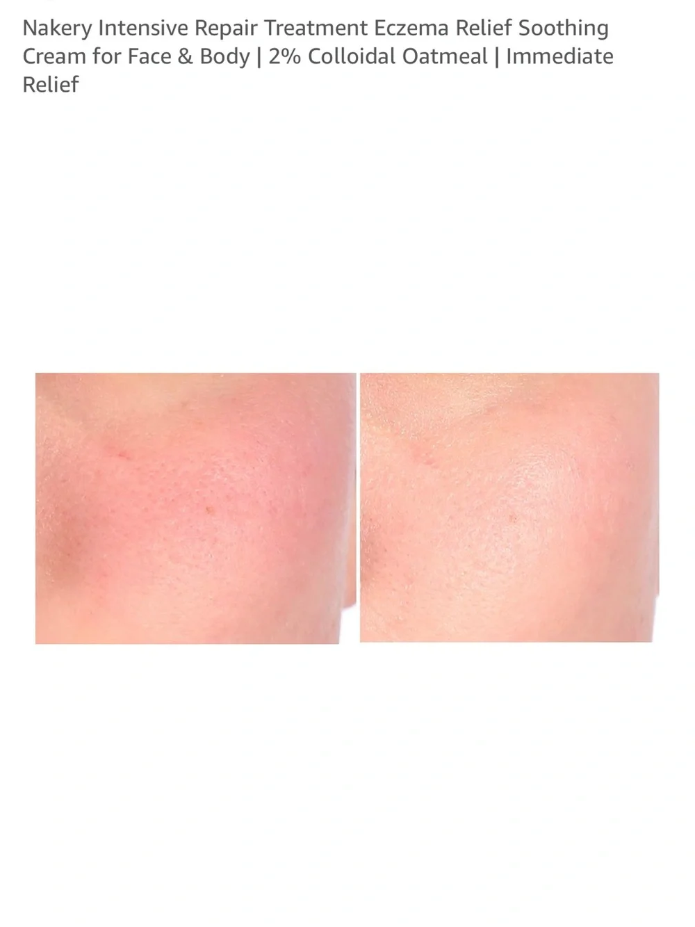 Nakery Blue Soothing Eczema Relief Cream for Face & Body